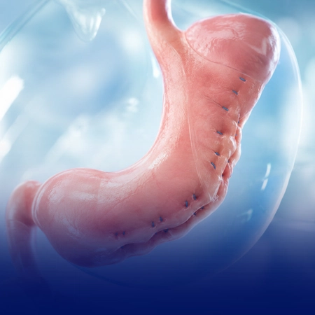 Endoscopia bariátrica